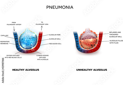Pneumonia illustration, alveoli with fluid and healthy Alveoli, oxygen and carbon dioxide exchange between alveoli and capillaries.