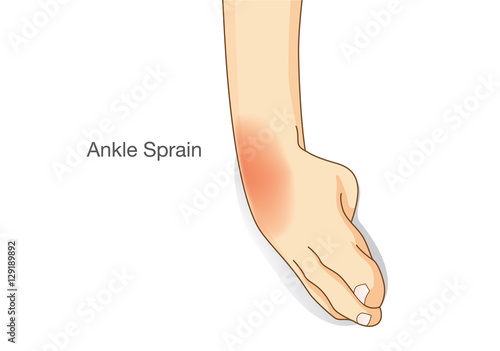 Ankle sprain and swelled. This illustration about common foot injuries.