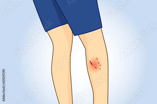 Dog bite wounds on calf leg. Rear view. Illustration about medical and first aid.