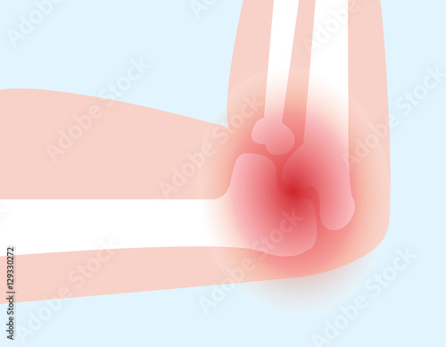illustration vector of elbow bone and joint pain