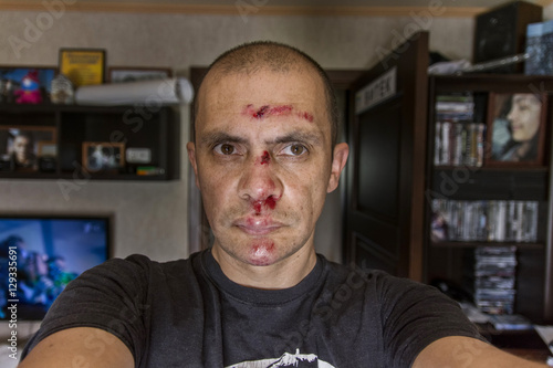 men portrait with an injured face  