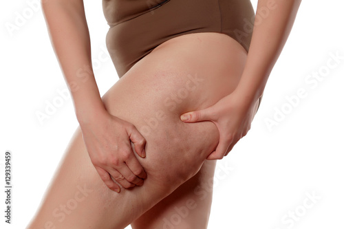 fat woman pinching her leg and showing cellulite