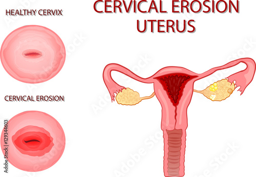 uterus. cervical erosion photo