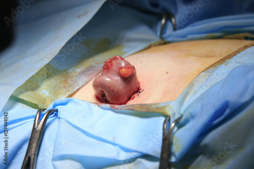 Intestine piece out of body sutured in a loop closeup making stoma at colostomy surgery photo