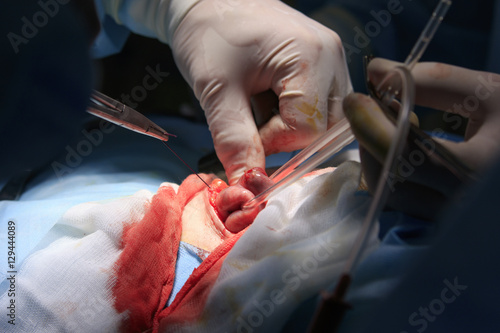 Surgeon tighten's the thread on an intestine during the colostomy surgery photo