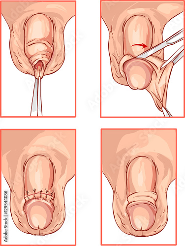    illustration of circumcision of the foreskin of the penis