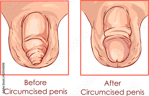 illustration of circumcision of the foreskin of the penis