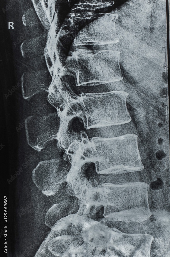 x-rays of the spine Stock Photo | Adobe Stock