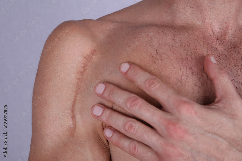 Man man with scar on his shoulder. Laser Scar Reduction concept Man man with scar on his shoulder. Laser Scar Reduction concept