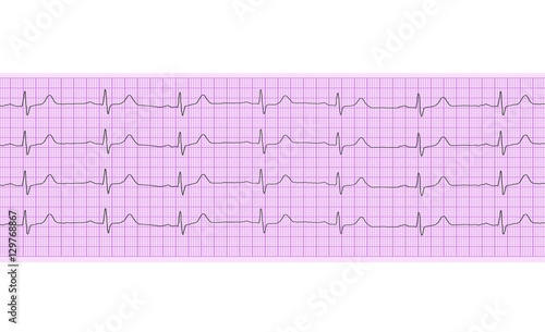 Heart analysis  electrocardiogram graph  ECG 