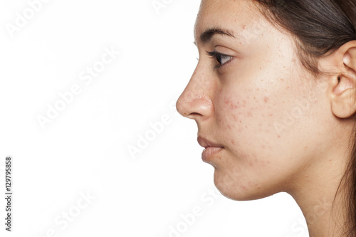 profile of young girl with acne on white background photo