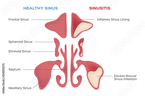 nasal sinus. Healthy and inflammation sinus vector