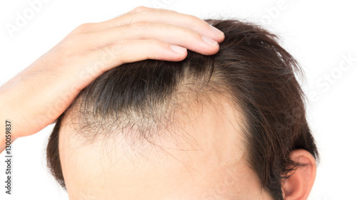 Young man worry hair loss problem for health care shampoo and be