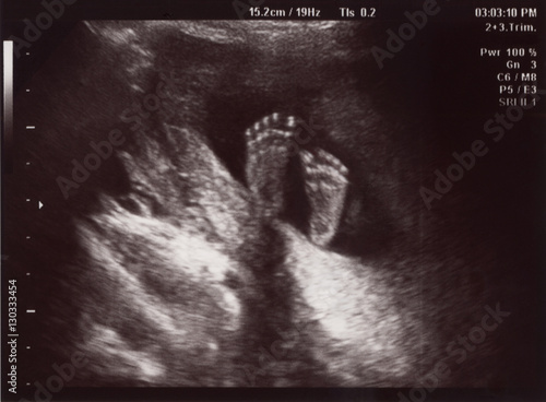 Canvas Print Ultrasound of In Uterus Baby at 22 weeks. Healthy baby in belly.