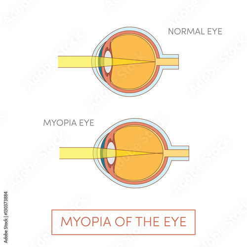 Fotografie Myopia of the eye