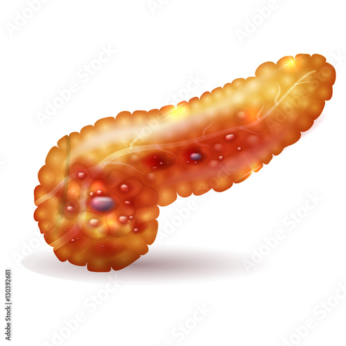 Pancreatitis illustration, inflammation of pancreas on a white background