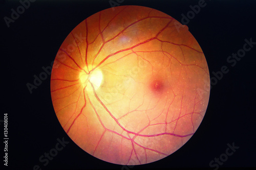 Fototapeta Naklejka Na Ścianę i Meble -  diabetes retinopathy.