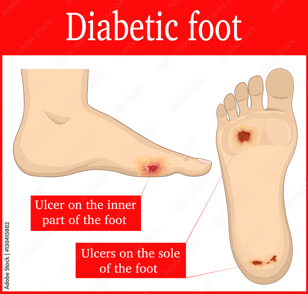 FDA permits marketing of new device for treating diabetic foot ulcers -  American Nurse Today