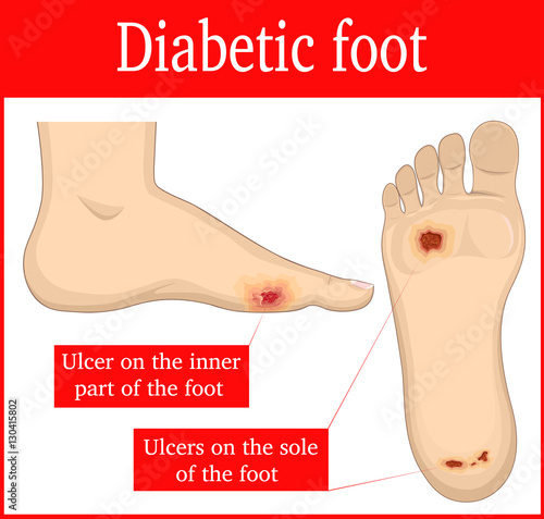 Illustration of ulcers that occur in diabetic foot syndrome