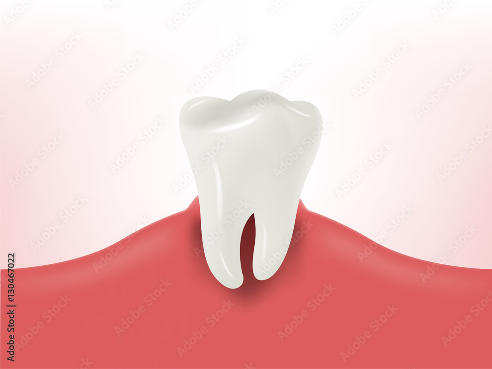 beautiful illustration of realistic tooth on gum, dental health design concept, decayed tooth beautiful illustration of realistic tooth on gum, dental health design concept, decayed tooth