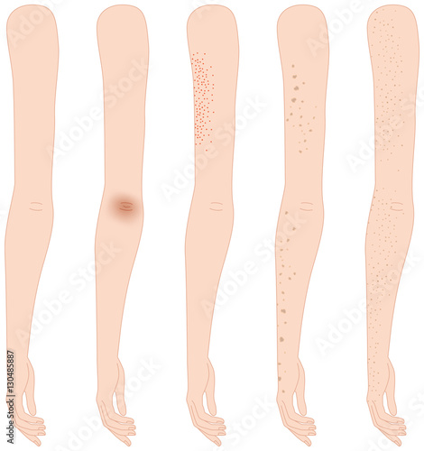 腕のしみ・黒ずみ