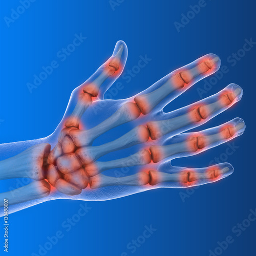 Arthrose in den Händen