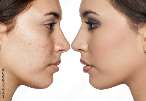 Schilderij op canvas Comparison portrait of a woman with problematic skin without and with makeup