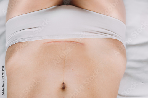 Closeup of woman belly with a scar from a cesarean section photo