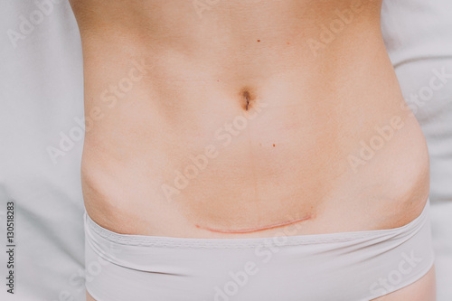 Closeup of woman belly with a scar from a cesarean section © dashamuller