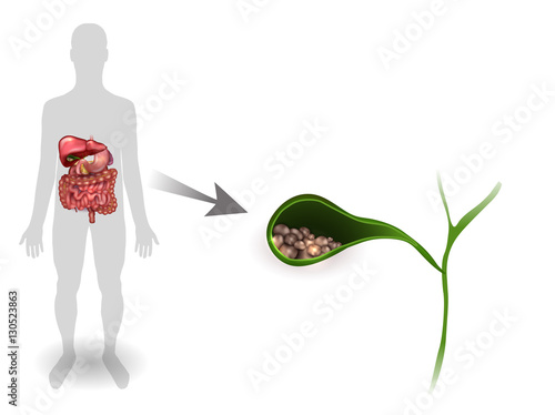 Gallstones in the Gallbladder, anatomy bright detailed illustration