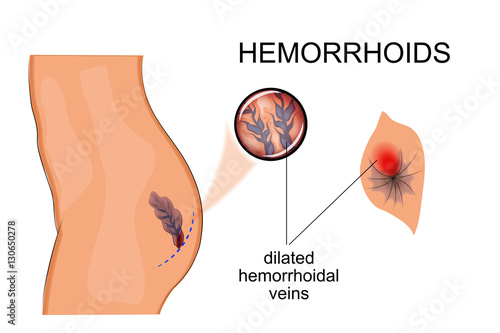 dilated veins hemorrhoids photo