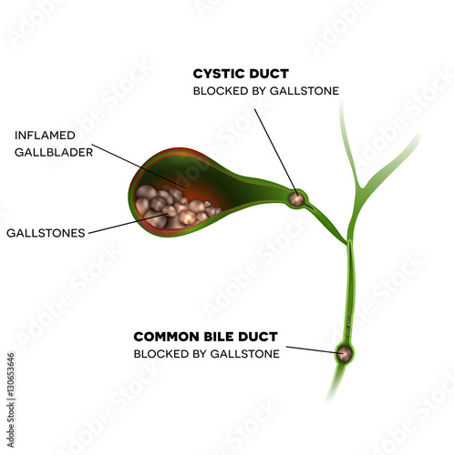 Gallstones in the Gallbladder, cystic duct and common bile duct, inflamed gallbladder.