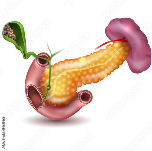 Gallstones in the Gallbladder and anatomy of duodenum, pancreas and spleen.