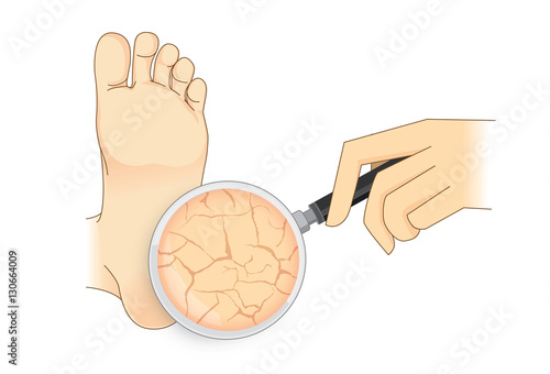 Small circles dead skin on the bottom of soles and toes. Calluses. Illustration about symptoms and pain on foot.