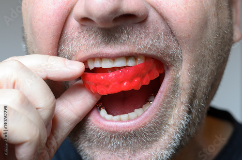 Fototapeta Naklejka Na Ścianę i Meble -  Man placing a red bite plate in his mouth