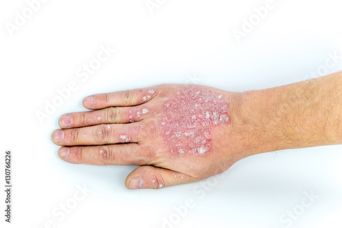 psoriasis on the hand isolated on white