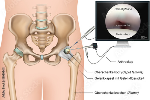 Arthroskopie der Hüfte, vektor illustration mit Beschreibung deutsch