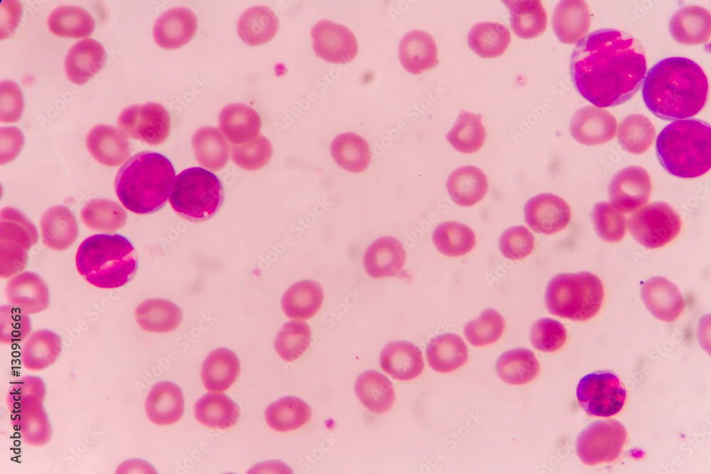 Blast cells in Leukemia