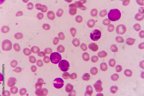 Blast cells in Leukemia