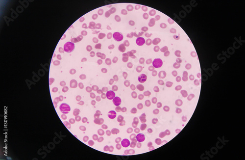 Blast cells in Leukemia