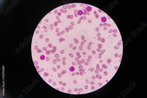 Blast cells in Leukemia