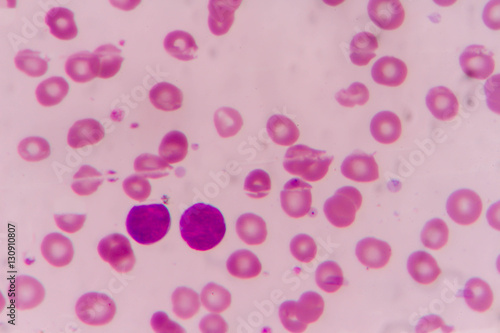 Blast cells in Leukemia