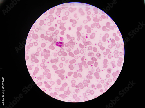 Slide blood smear show giant platelet and neutrophil under micro