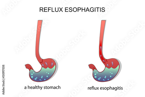 reflux esophagitis stomach. photo