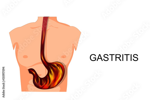 reflux esophagitis stomach. photo