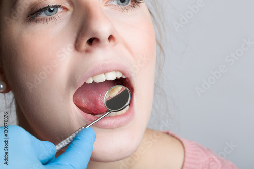 Mund einer jungen Frau bei der Untersuchung beim Zahnarzt mit dem Zahnspiegel
