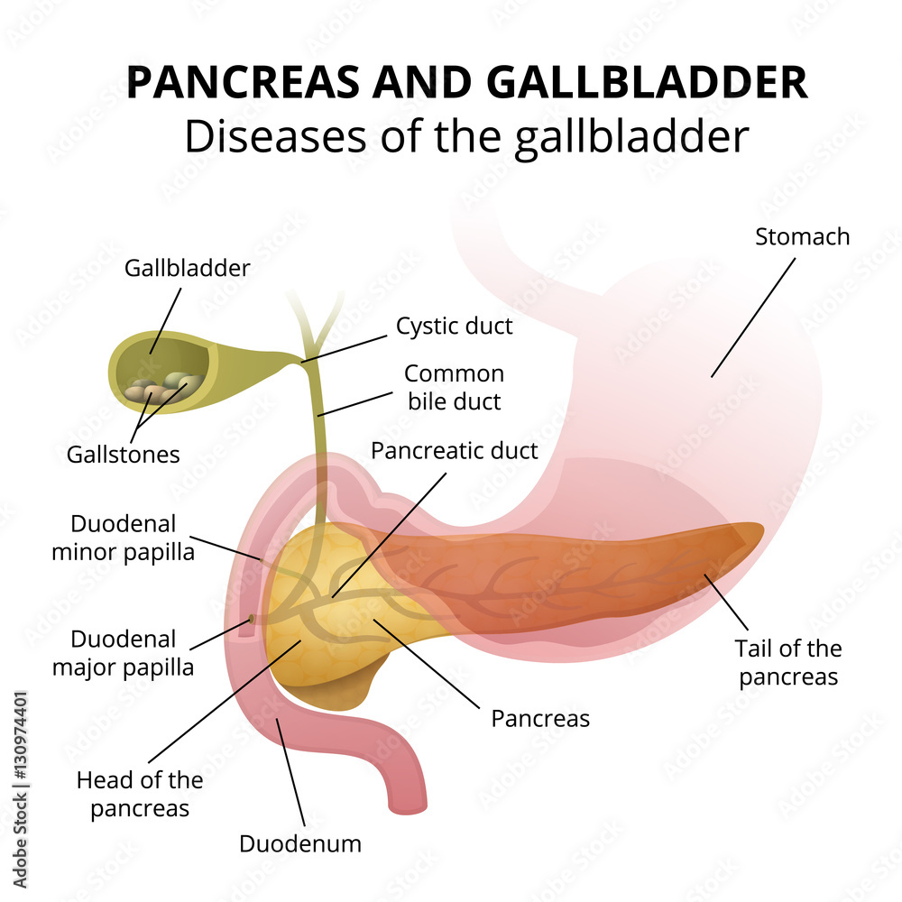 Obraz premium gallbladder disease - gallstone