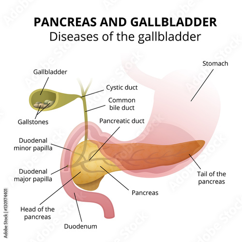 gallbladder disease - gallstone photo