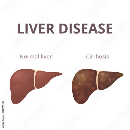 cirrhosis of the liver