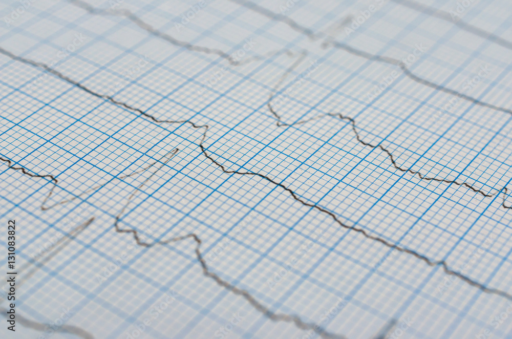 Close up of an electrocardiogram in paper form